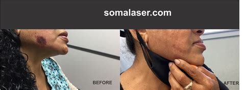 Laser Skin Rejuvenation In New Jersey Soma Skin And Laser