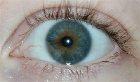 Are My Eyes Blue With Central Heterochromia Reyes