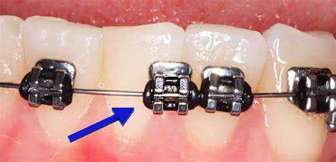 Braces Problems And Solutions Yang Orthodontics