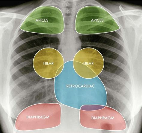 Hidden Areas Of Chest Medical Radiography Medical Anatomy Medical