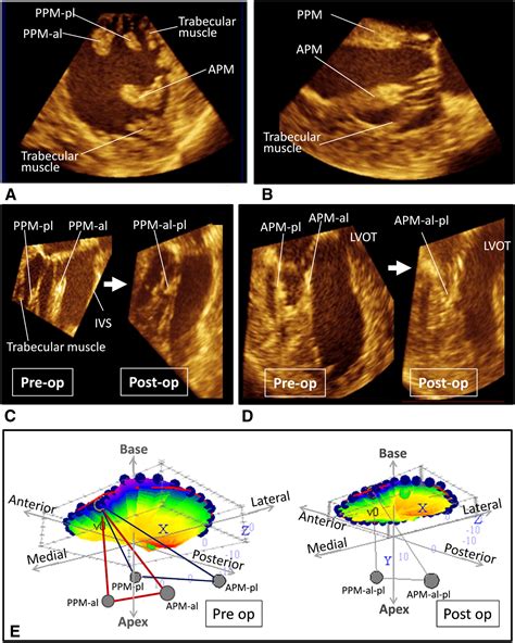 A New Echocardiographic Window To Visualize The Mitral Valve Complex During Mitral Valve Repair