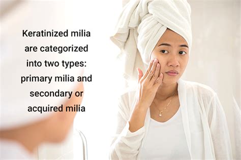 Milia Causes Treatment And Prevention Emedihealth