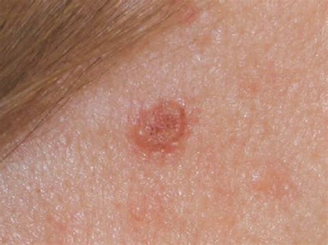 Basal Cell Skin Cancer On Face Cancerwalls