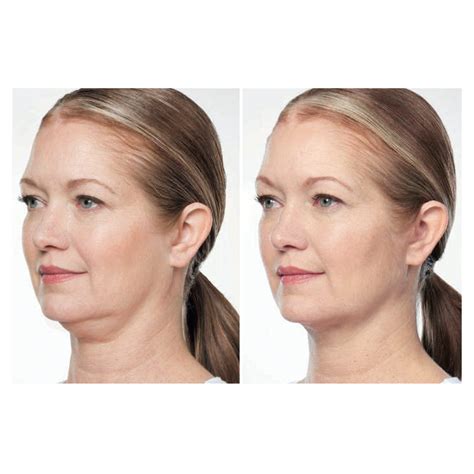 📸before And After Kybella Kybellahtm