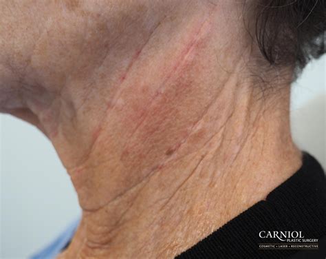 Non Surgical Neck Lift Before And After Gallery