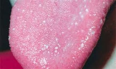 Small Bumps On Tongue Identified By Doctors As Potential Coronavirus