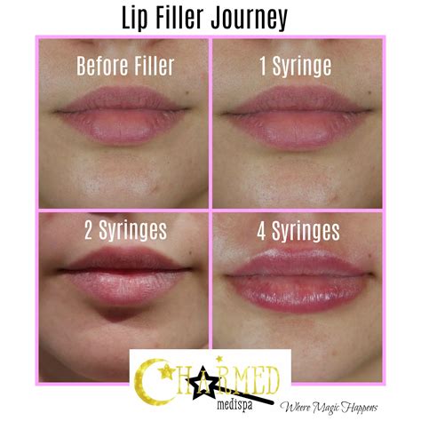 Juvederm Lips Before And After 12 Syringe Lips The Results Can