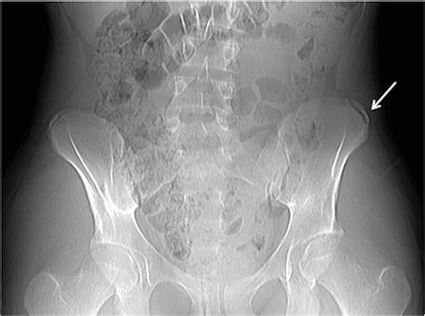 Frontal Pelvis Radiograph Showing A Mildly Displaced Avulsion Fracture