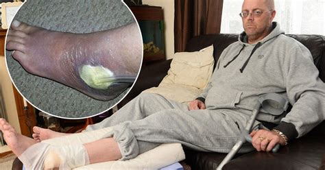Man Feared Having Foot Amputated After Bite From Britains Most