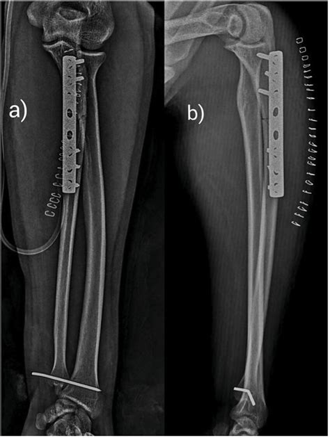 Immediate Postoperative Anteroposterior A And Lateral B Radiographs