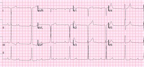The ecg shows complete heart block with a broad complex escape rhythm. Image result for complete heart block 12 lead ecg | Heart ...