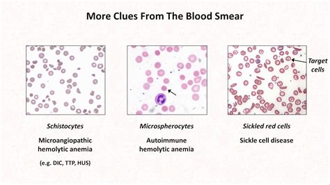 Anemia Lesson 4 Clues From The Blood Smear Youtube