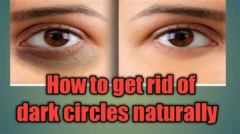 How To Get Rid Of Dark Circles In 2 Steps Youtube