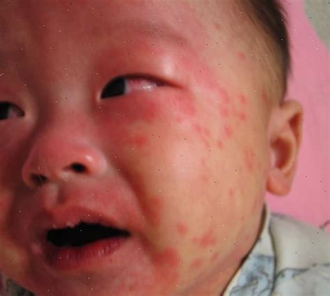 Doença de kawasaki é uma doença de causa desconhecida que resulta em febre e afeta sobretudo crianças com idade inferior a cinco anos. A doença de Kawasaki – Payro