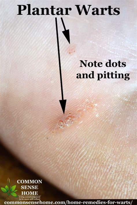 Plantar Wart What Is It Symptoms Treatment And More Wart Remover Safe Natural Effective