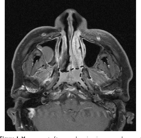 Figure 1 From Differential Diagnosis Of Primary Nasopharyngeal Lymphoma