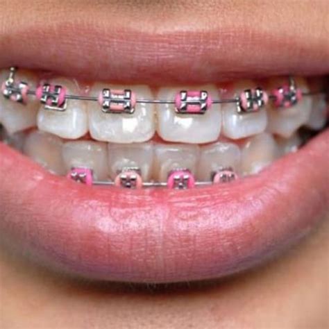 Fake Braces Are A Fashion Trend Among Youngsters In Southeast Asia Complex