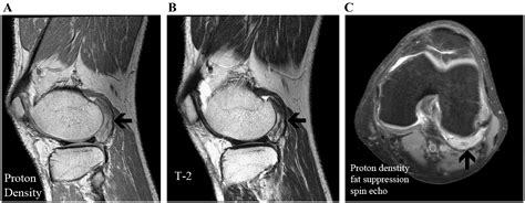 Intraarticular Fibroma Of The Posterior Compartment In The Knee The Knee
