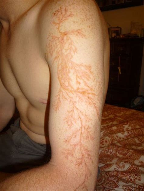 Lichtenberg Figure. Human Skin Struck by Lightning - Barnorama