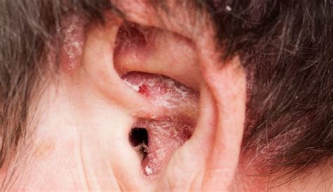 Dry Ear Infections Dry Ears Causes Treatment And More Website Wp