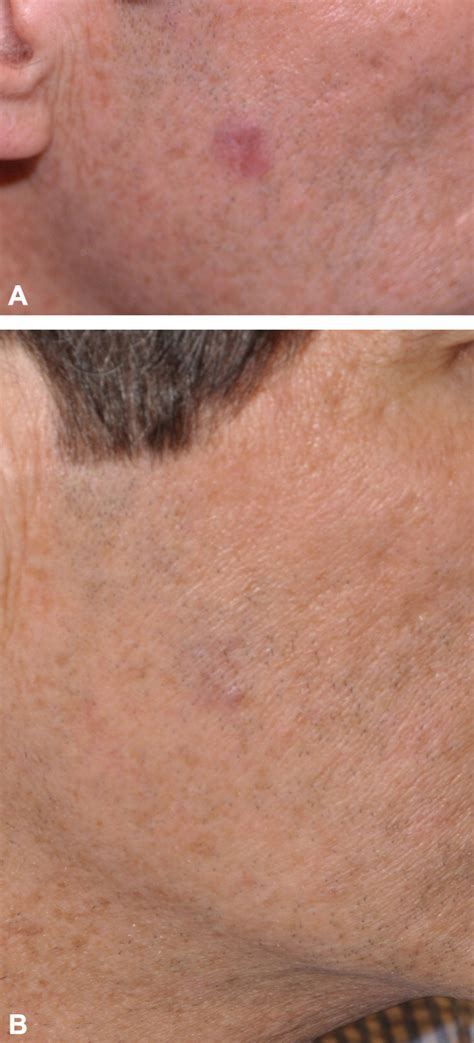 Primary Cutaneous B Cell Lymphomas Journal Of The American Academy Of