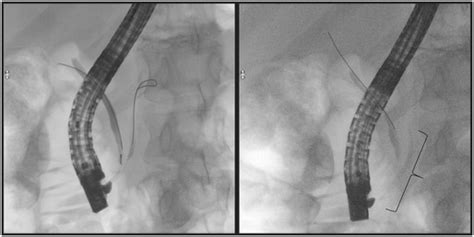 Pancreatic Wire Assisted Cannulation Followed By Pancreatic Stent
