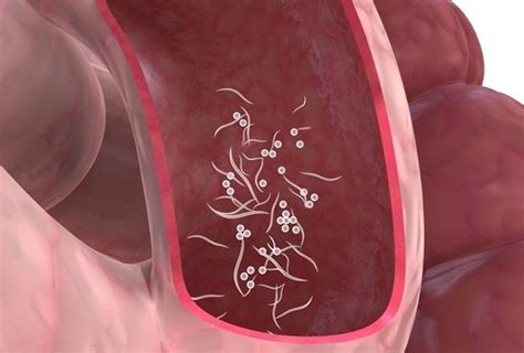 Síntomas De La Presencia De Parásitos En El Intestino