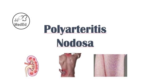 Polyarteritis Nodosa Pan Signs And Symptoms Diagnosis Treatment