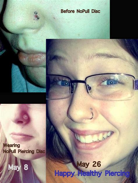 Keloid Scar On Nose Piercing