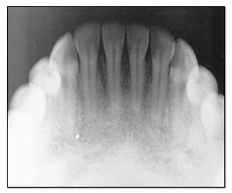 Intraoral Radiographic Techniques Intraoral Occlusal Radiography