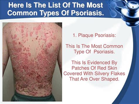 Ppt The Five Main Types Of Psoriasis Powerpoint Presentation Free