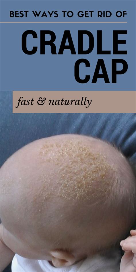 Best Ways To Get Rid Of Cradle Cap Fast And Naturally Beauty Insider