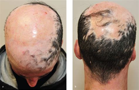 Case 52 Scalp Burn Reconstruction Plastic Surgery Key