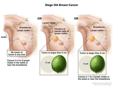 Breast cancer stage is determined by anatomical features of the cancer, like size, as well as the tumor's biological characteristics. Stadia van borstkanker | Health Life Media