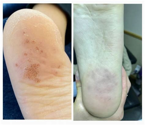 Swift Microwave Wart Treatment Review Before And After Photos Dr