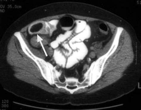 Imaging And Findings Of Lipomas Of The Gastrointestinal Tract Ajr