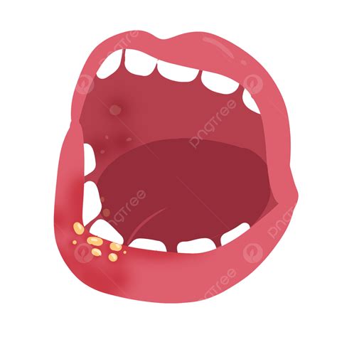 Albums 102 Pictures Mouth Ulcers On Gum Pictures Excellent