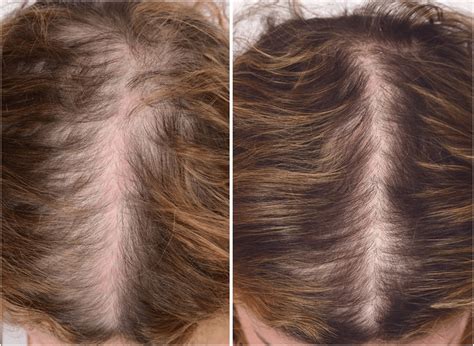 A 46 Year Old Woman With Androgenetic Alopecia Before And 3 Months