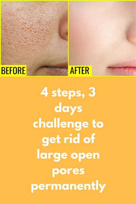 4 Steps 3 Days Challenge To Get Rid Of Large Open Pores Permanently If