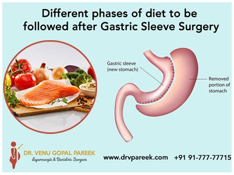 Different Phases Of Diet To Be Followed After Gastric Sleeve Surgery