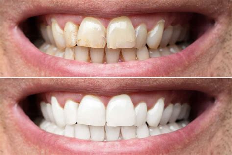 Teeth Whitening Smiles That Matter