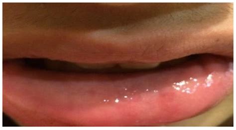 Applied Sciences Free Full Text Excision Of Lower Lip Mucocele
