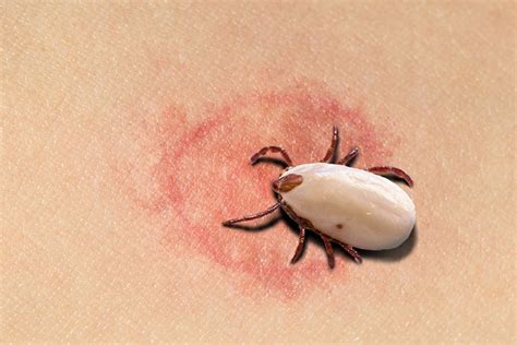 Ticks Bites On Children Signs Treatment And First Aid