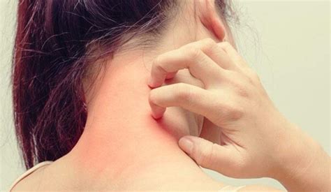 Dermatite Da Stress Cause Sintomi E Cura Sanioggi It