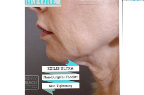 Exilis Ultra Non Surgical Face Lift San Diego Skin Tightening Ca
