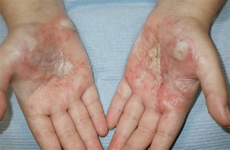 10 Natural Ways To Get Rid Of Herpes On Hands Fast