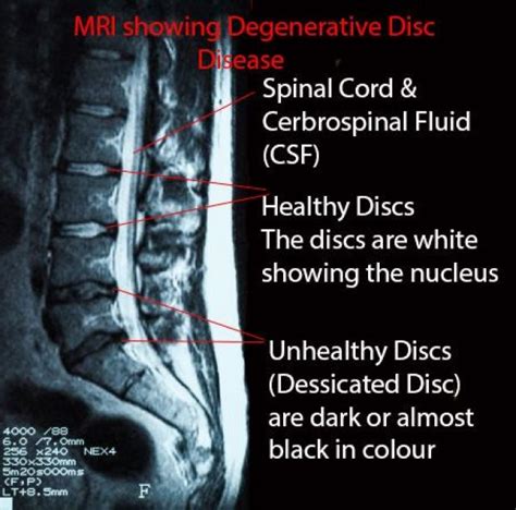 Mri Showing The Lower Back With Healthy Disc Near The Top With The