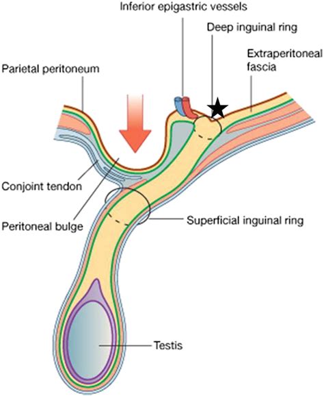 Crossing The Canal Looking Beyond Hernias — Spectrum Of Common Uncommon And Atypical