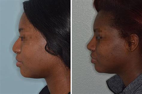 African American Rhinoplasty In Miami Fl Dr Anthony Bared