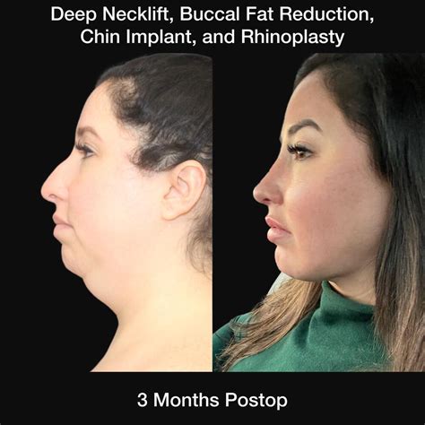 Before And After Buccal Fat Removal Procedures In St Louis Mo Nayak